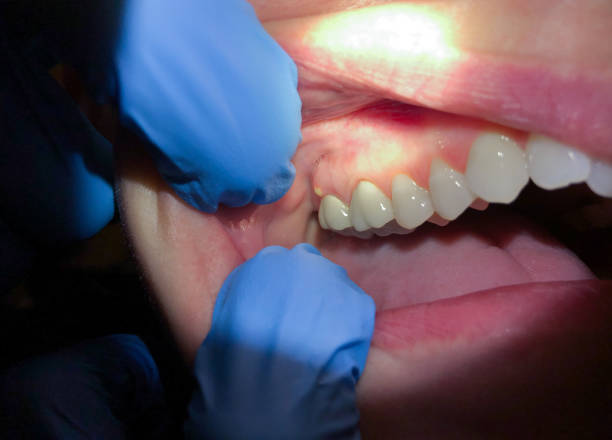 Best Knocked-Out Tooth (Avulsed Tooth) Treatment in Green Cove Springs, FL
